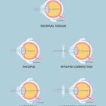 Myopia Concept Visualization