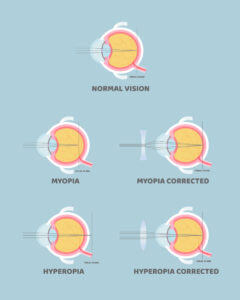 Myopia Concept Visualization